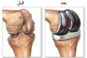 درمان آرتروز بدون دارو در خانه!